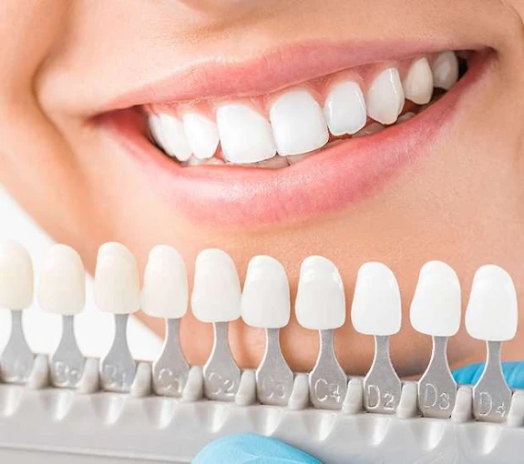 Dental Veneers