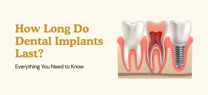 How Long Do Dental Implants Last (2)