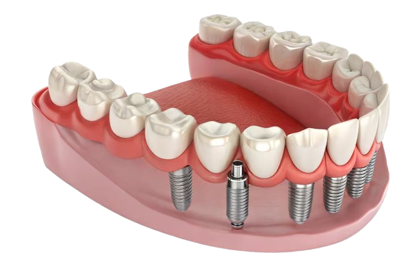 How Long Do Dental Implants Typically Last
