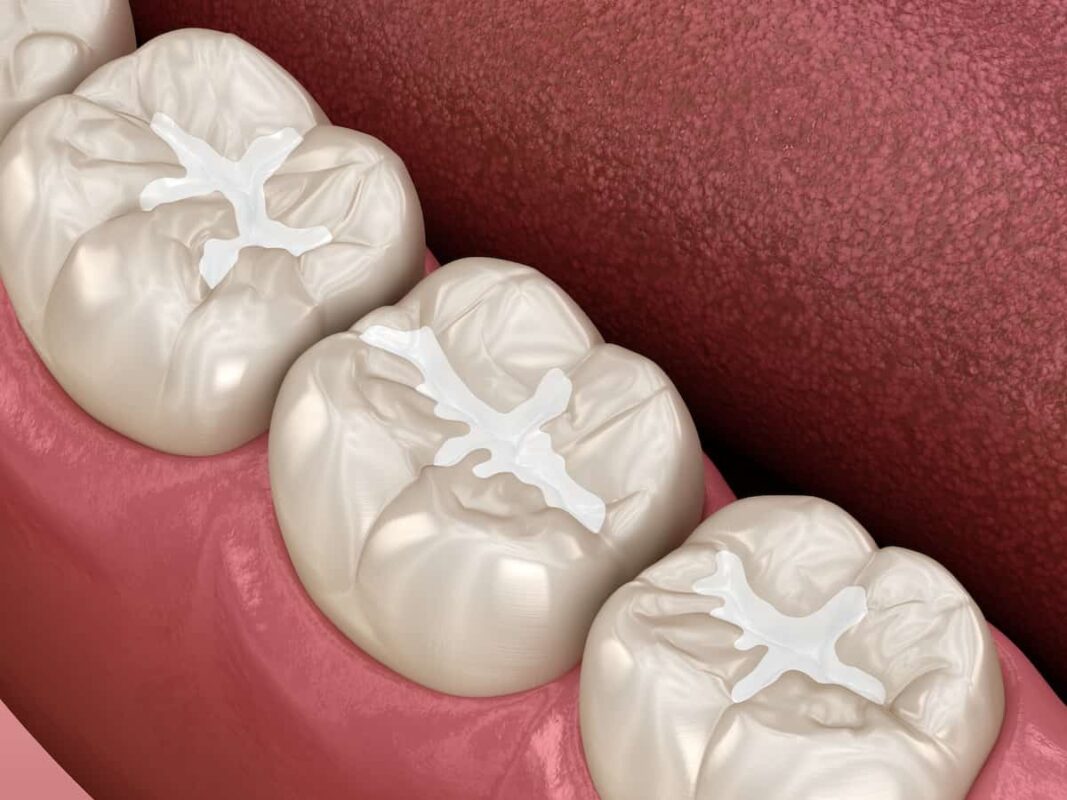 Dental Sealants in Stamford