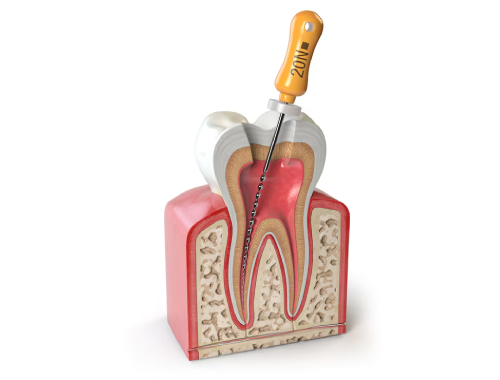 What Is a Root Canal Treatment?