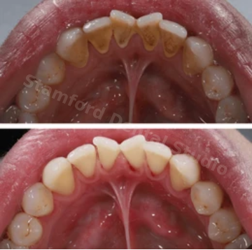 Dental Cleaning in Stamford, CT
