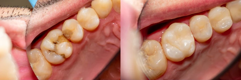 Dental Fillings in Stamford, CT (1)