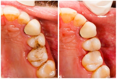 Dental Fillings in Stamford, CT