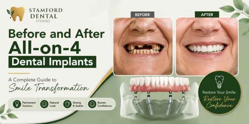 Before and After All-on-4 Dental Implants. A Complete Guide to Smile Transformation