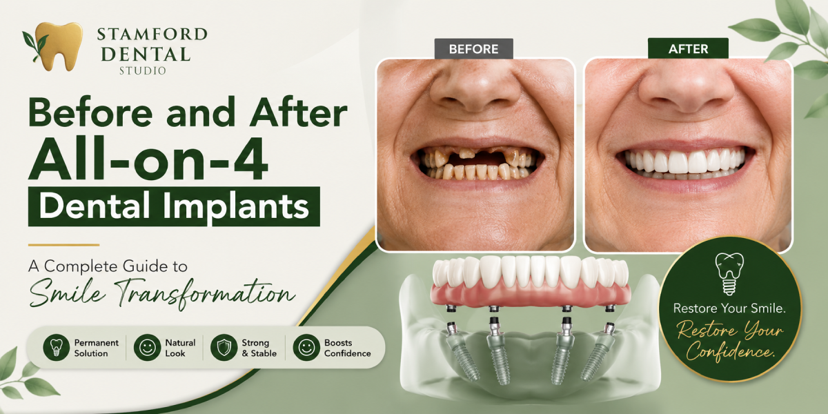 Before and After All-on-4 Dental Implants. A Complete Guide to Smile Transformation