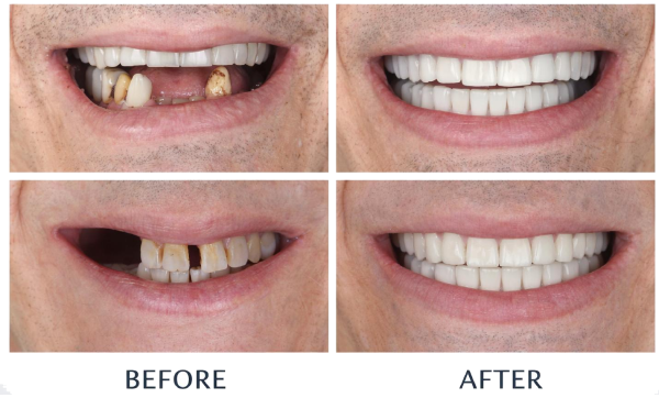 Missing Teeth Before Implant Treatment