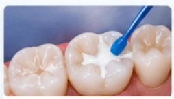 Dental Sealants